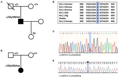 Genetics of Paroxysmal Dyskinesia: Novel Variants Corroborate the Role of KCNA1 in Paroxysmal Dyskinesia and Highlight the Diverse Phenotypic Spectrum of KCNA1- and SLC2A1-Related Disorders